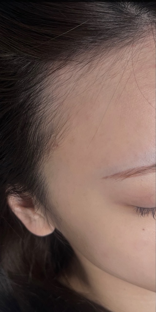 生え際 Before